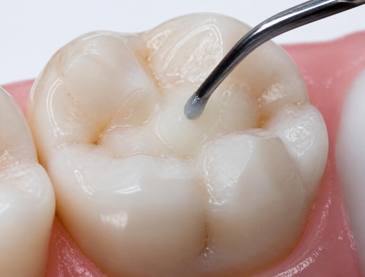 Macro close-up of tooth-colored packable composite resin being applied and contoured onto a molar