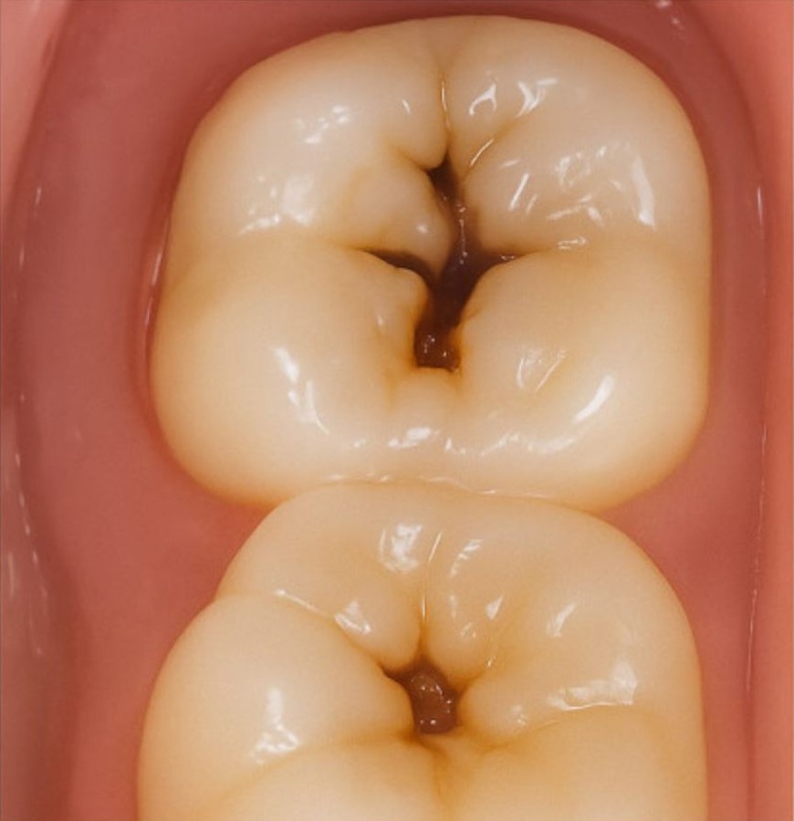 Close-up of a molar with visible decay before treatment.